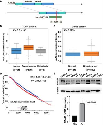 Knockdown of NAA25 Suppresses Breast Cancer Progression by Regulating Apoptosis and Cell Cycle